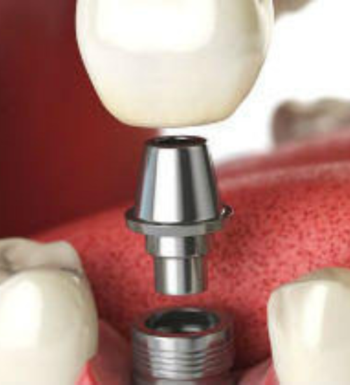 Dental Implants